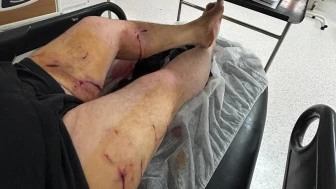 KÜÇÜK KIZI KÖPEKTEN KURTARMAYA  ÇALIŞIRKEN KENDİ SALDIRIYA UĞRADI