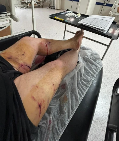 KÜÇÜK KIZI KÖPEKTEN KURTARMAYA  ÇALIŞIRKEN KENDİ SALDIRIYA UĞRADI